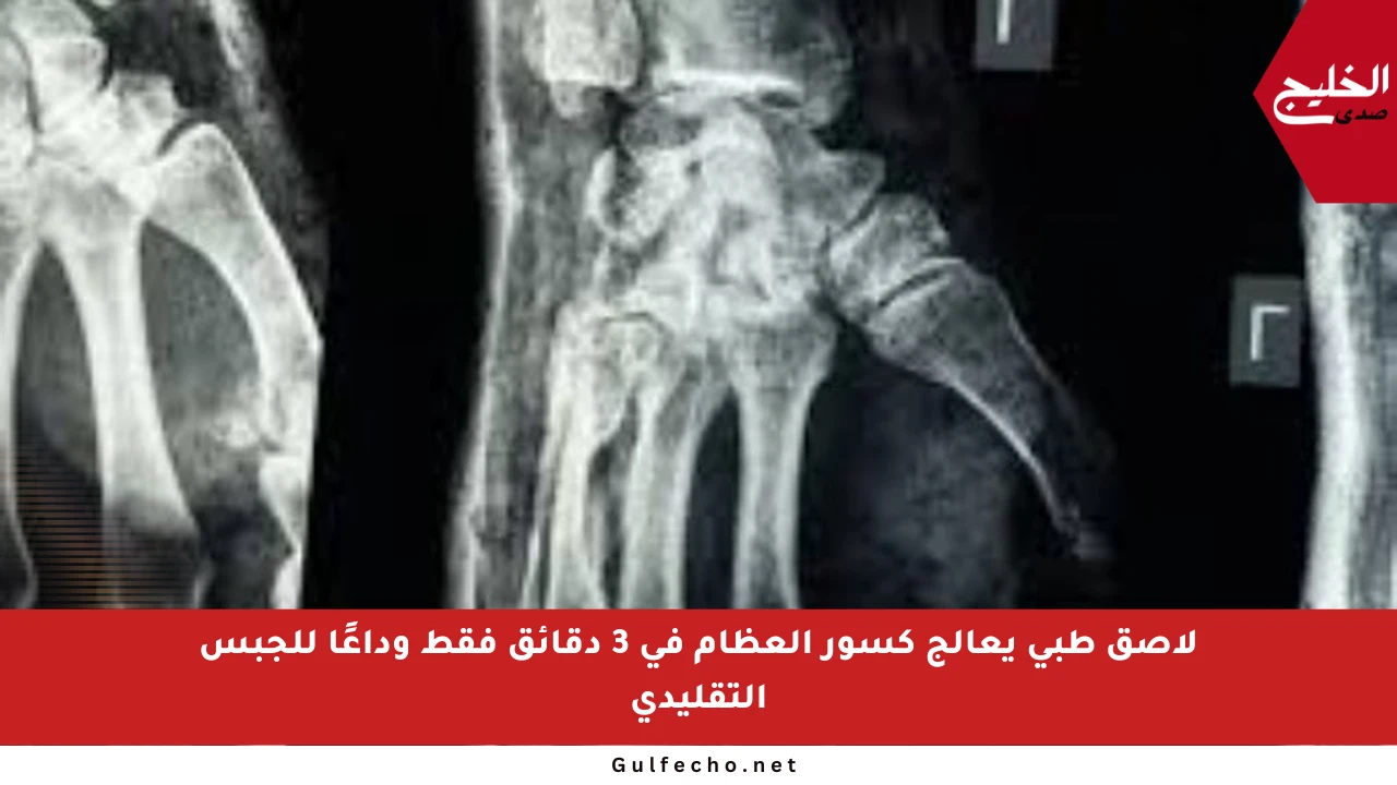 لاصق طبي يعالج كسور العظام في 3 دقائق فقط وداعًا للجبس التقليدي